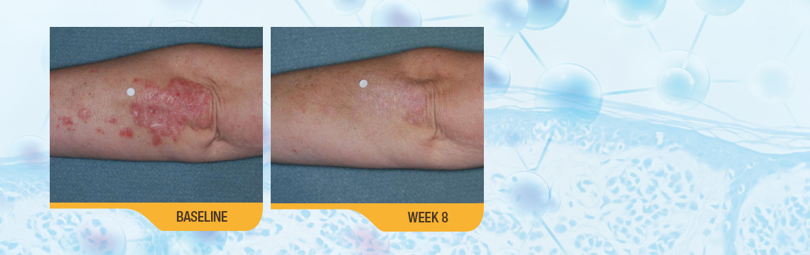 The Results Speak For Themselves. SORILUX Foam Has Been Proven Effective For Body Psoriasis