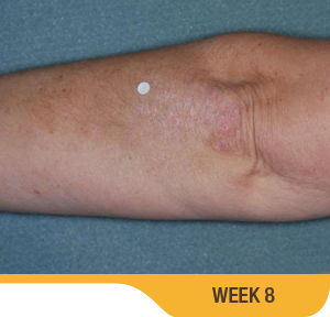 Baseline And 8 Weeks Elbow Results Photo Of An Actual Patient Who Achieved Treatment Success With SORILUX Foam