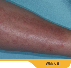 Baseline And 8 Weeks Leg Results Photo Of An Actual Patient Who Achieved Treatment Success With SORILUX Foam