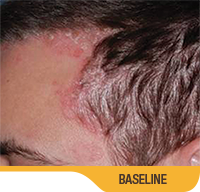 Baseline And 8 Weeks Scalp Results Photo Of An Actual Patient Who Achieved Treatment Success With SORILUX Foam